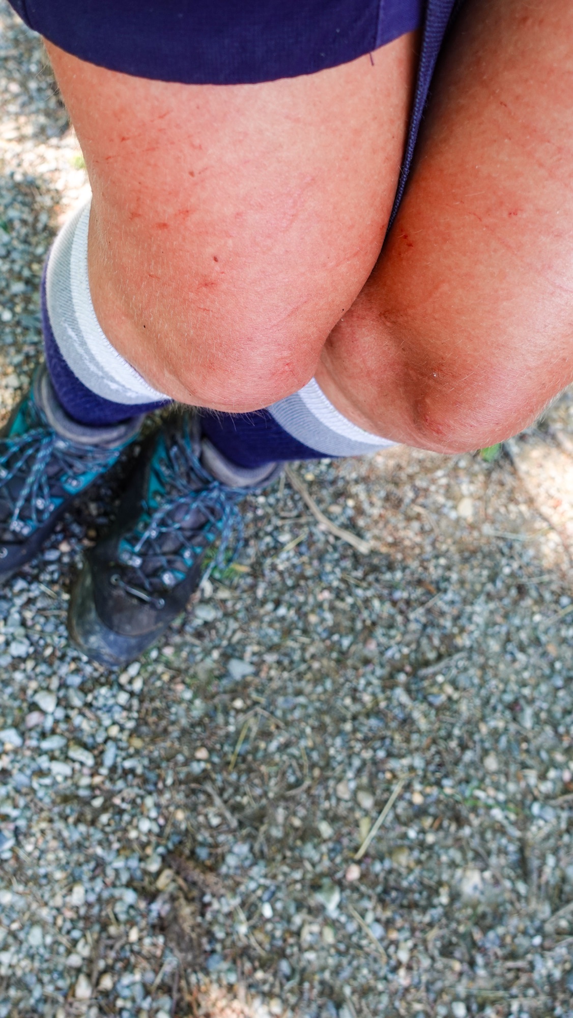 Von Sträuchern zerkratzte Beine